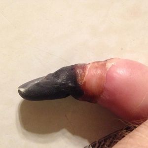 Day of surgery, before removal.