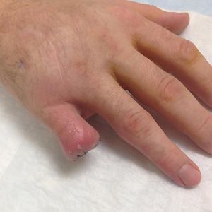 Week and a half after removal. Lot less pain and looks like it's healing well.